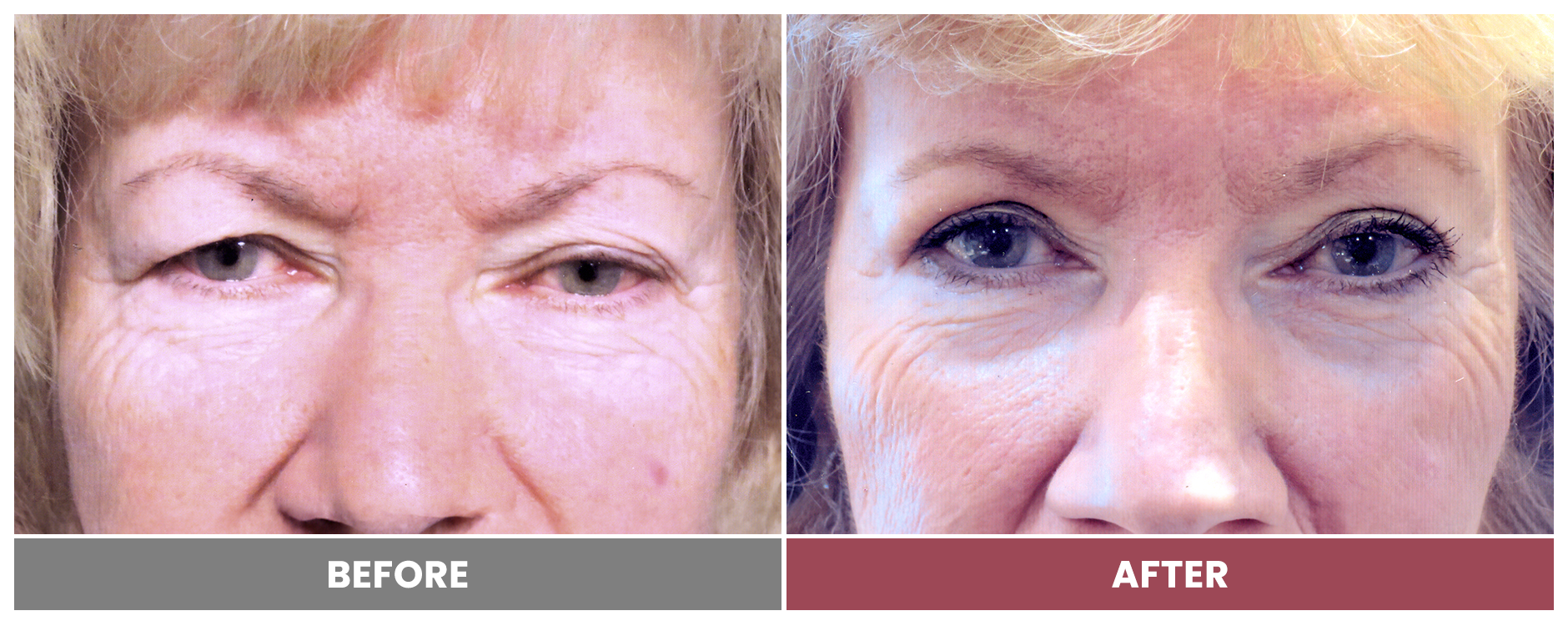 Upper Blepharoplasty - Case 15
